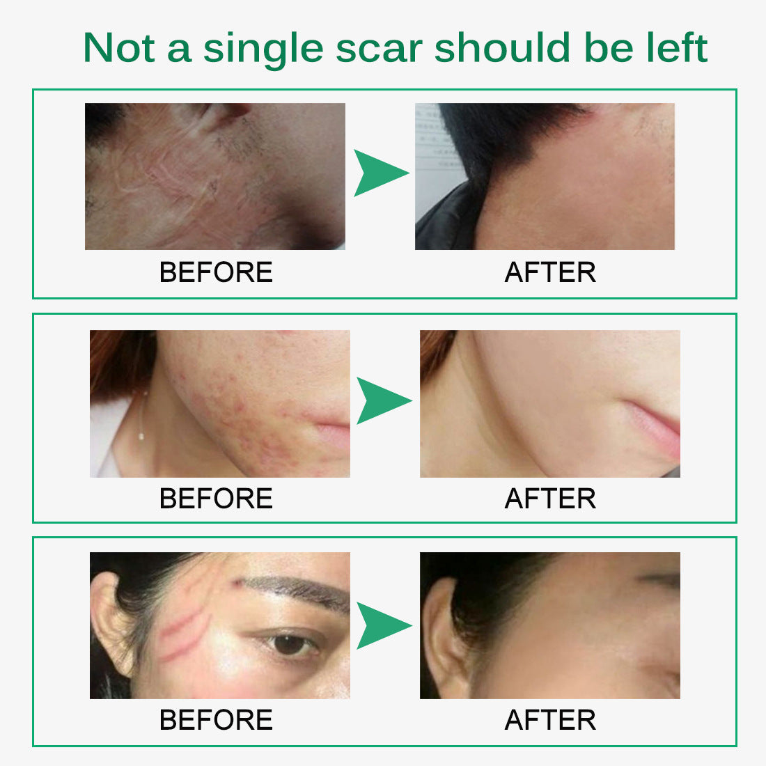 Skin  Scarless Cream Skin Repair Strech Mark Recover X  With Cayman Peptide