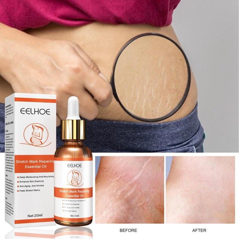 Stretch Marks Remover Essential Oil Skin Care Treatment Cream For Scar Care